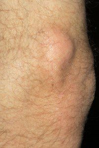 Calcinosis cutis over the left elbow