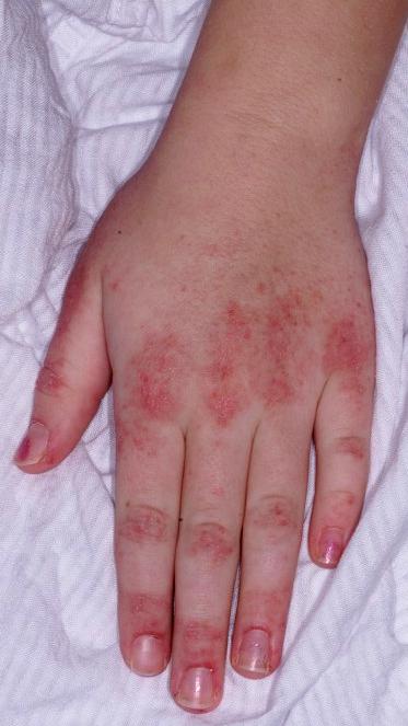 myositis skin rash