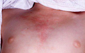 An erythematous "V-neck" rash is present on the upper chest