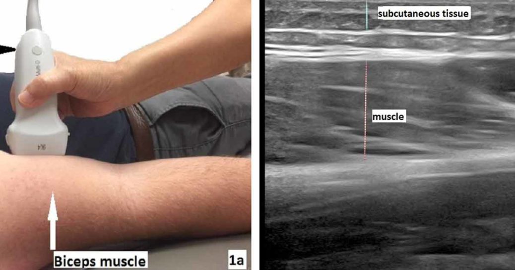 Ultrasound elastography in neuromuscular and movement disorders